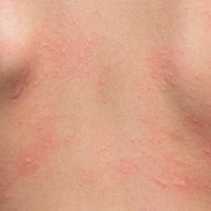 Portland Allergic Contact Dermatitis Treatment