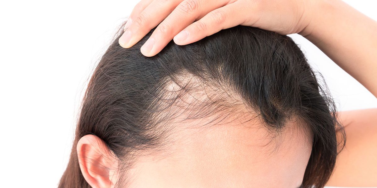 Androgenetic Hair Loss Treatment