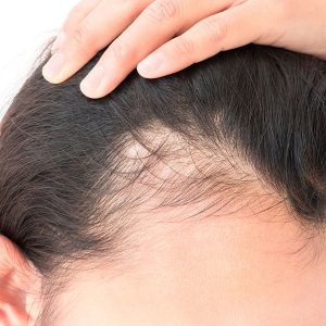 Portland Female Hair Loss Treatment