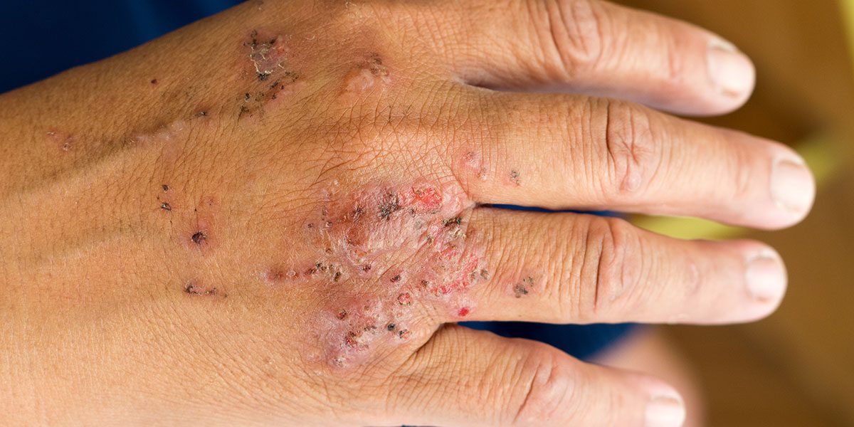 Hand Dermatitis Treatment