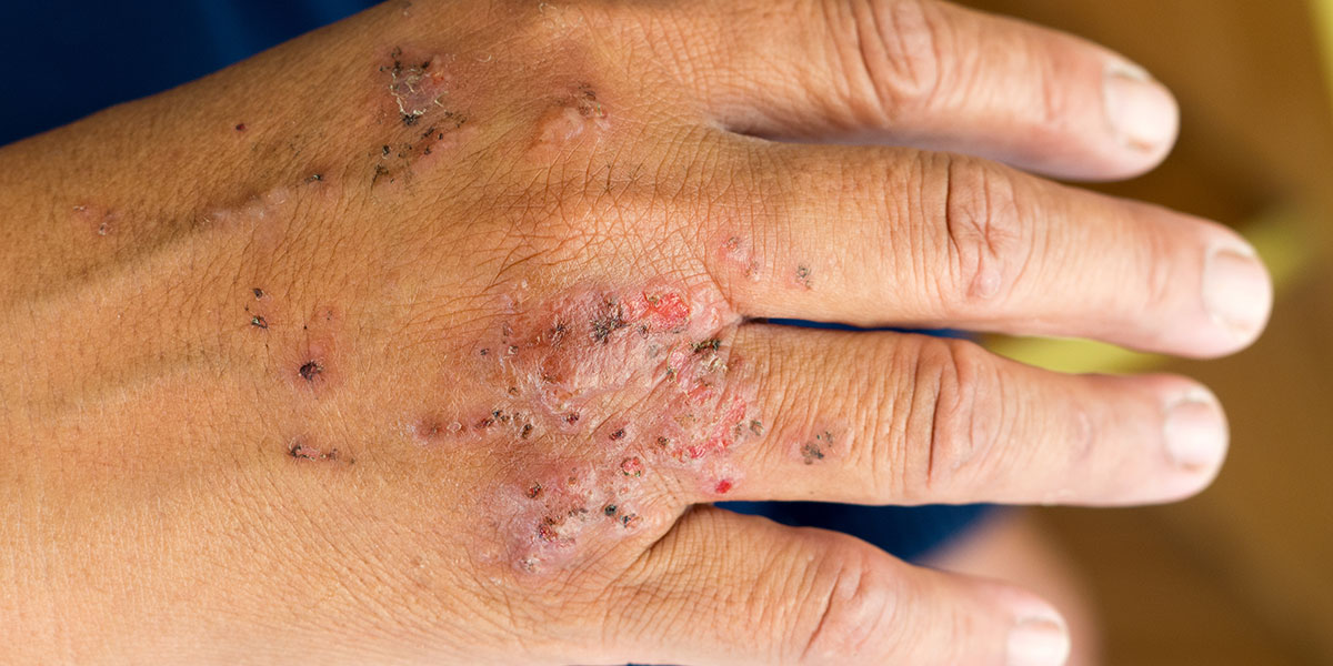 Portland Hand Dermatitis Treatment | Norris Dermatology & Laser