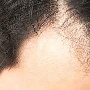 Hair Loss Treatment | Norris Dermatology & Laser Northwest Portland