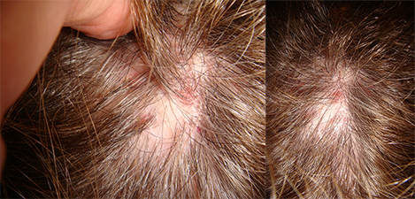 Portland Scarring Alopecia Treatment