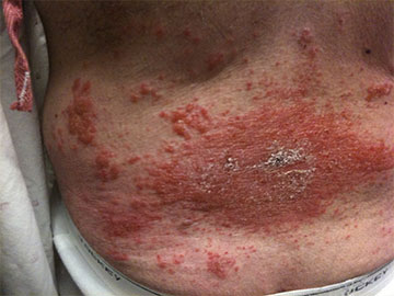 Portland Skin Allergy Testing