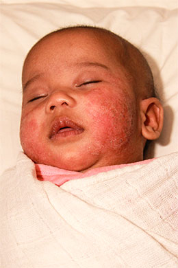Portland Infant Eczema Treatment