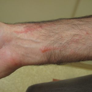Allergic Contact Dermatitis